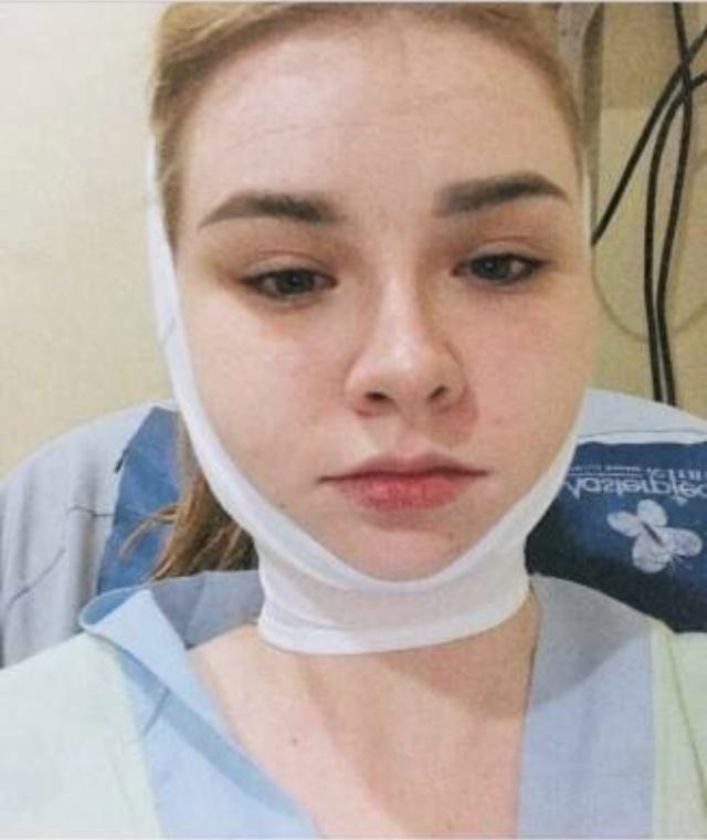 原创jessievard抛出整容全过程垫胸抽脂隆鼻等看着就感觉疼