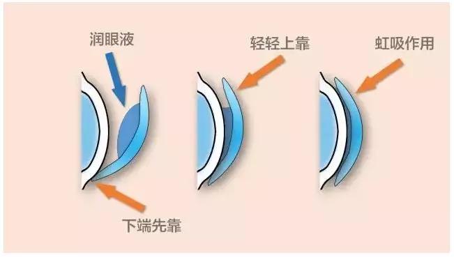 新手佩戴角膜塑形鏡常遇見哪些問題