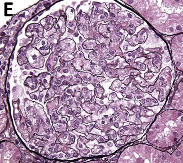 活检病理切片免疫化学染色提示大量巨噬细胞浸润图 a为肾活检光镜结果