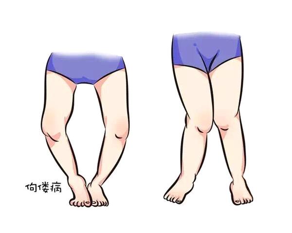 宝宝佝偻病是怎么回事该如何预防