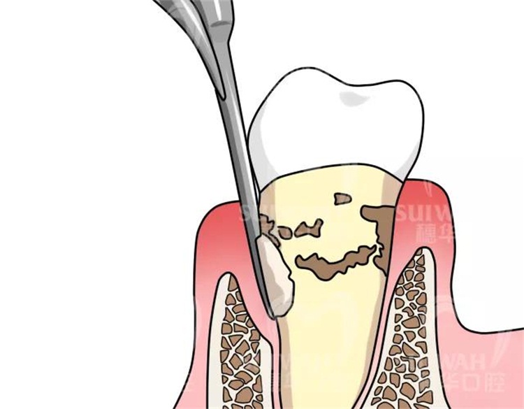 一旦你出现了牙龈疾病,牙周袋形成之后就会慢慢加深,牙结石就会慢慢向