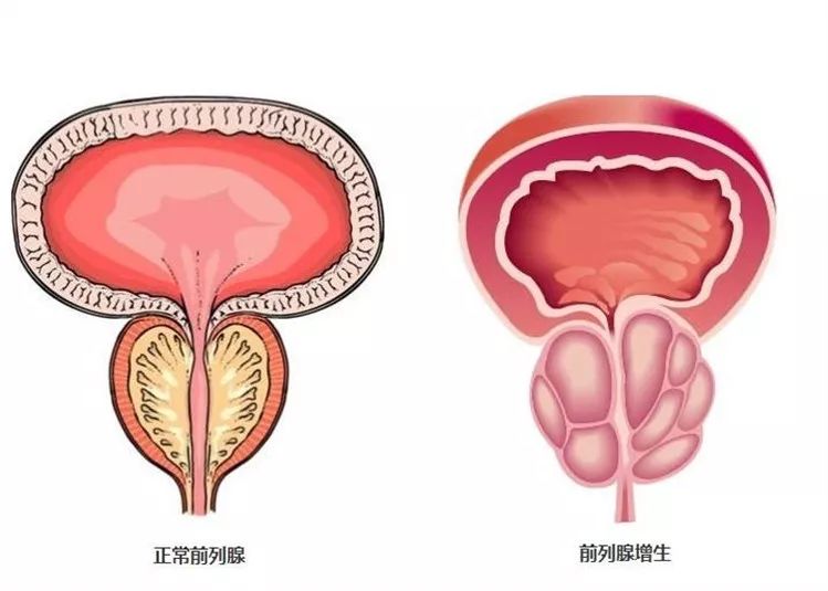 前列腺增生示意图图片