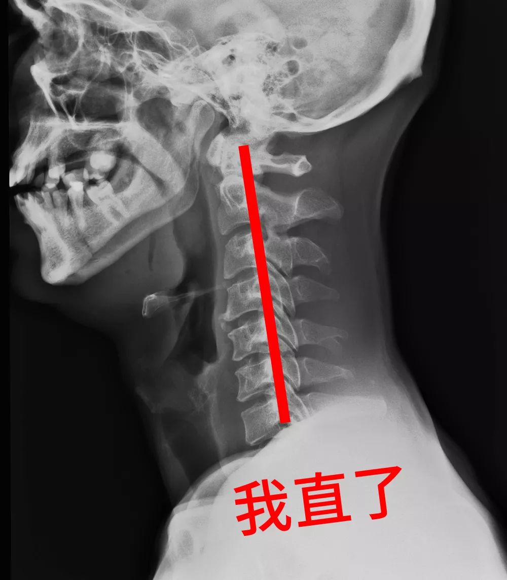 「颈椎曲度变直」形成我们常说的原本弯的颈椎,被肌肉强行掰直