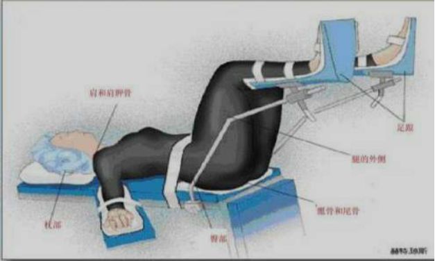 截石位:枕部双侧肩胛部骶尾部腘窝部俯卧位:眼部前额面颊部