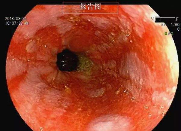 食管炎是什么症状图片