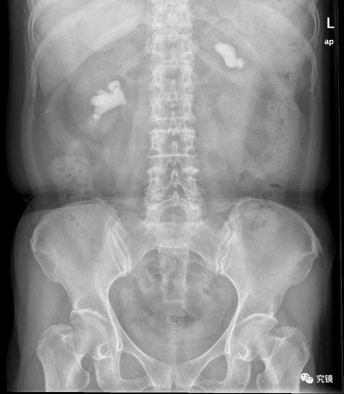 6℃,p:93次/分,r:19次/分,bp:141/84mmhg,心肺听诊无殊,腹平软,无压痛
