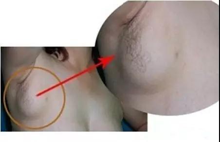 女性乳腺淋巴结肿大图图片