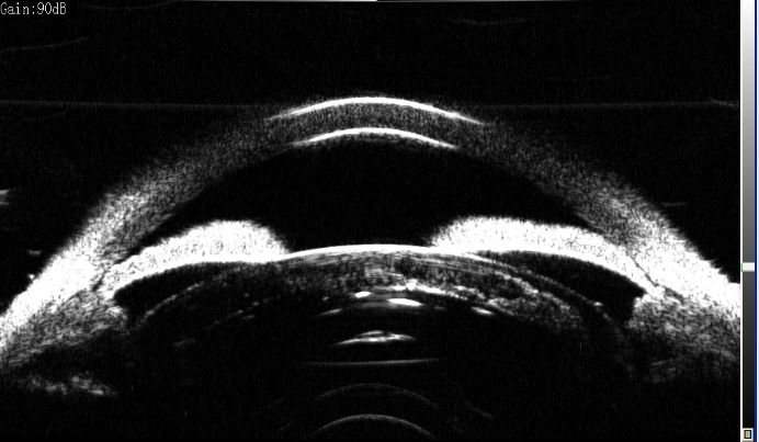 ubm及房角镜优缺点比较内窥镜技术通过传统的眼科手术显微镜很难直接