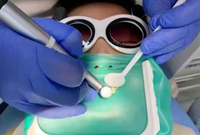 橡皮障的好处了解一下!_治疗