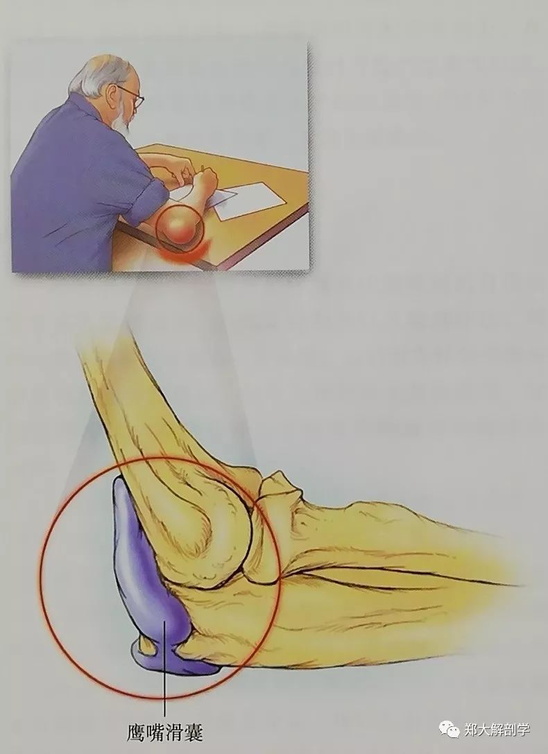 疼痛位于鹰嘴区域,肘关节以上区域可出现牵涉痛.