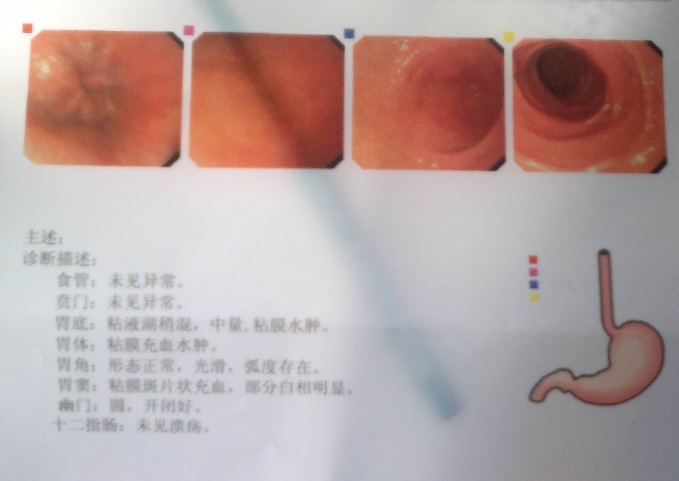 胃镜单解读浅表性胃炎胃黏膜的7大特征