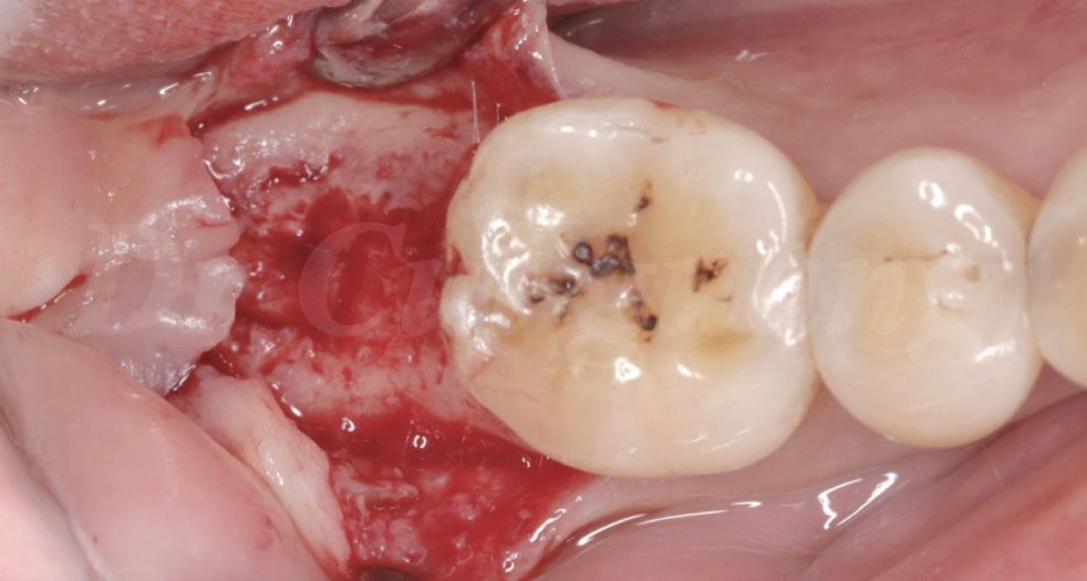 纤维蛋白和浓缩生长因子作为一种潜在的减少骨改建的生物材料已被广泛