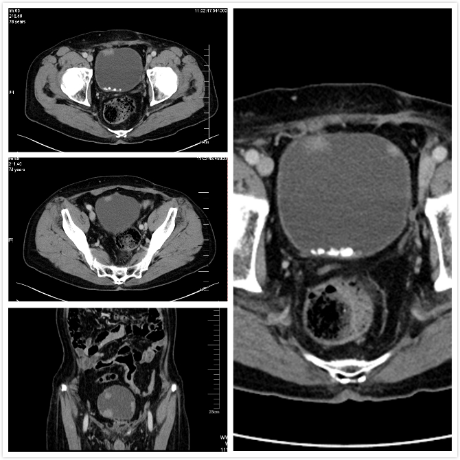 该患者系膀胱恶性肿瘤术后3年复发,超声及ct检查后发现膀胱内多发占位