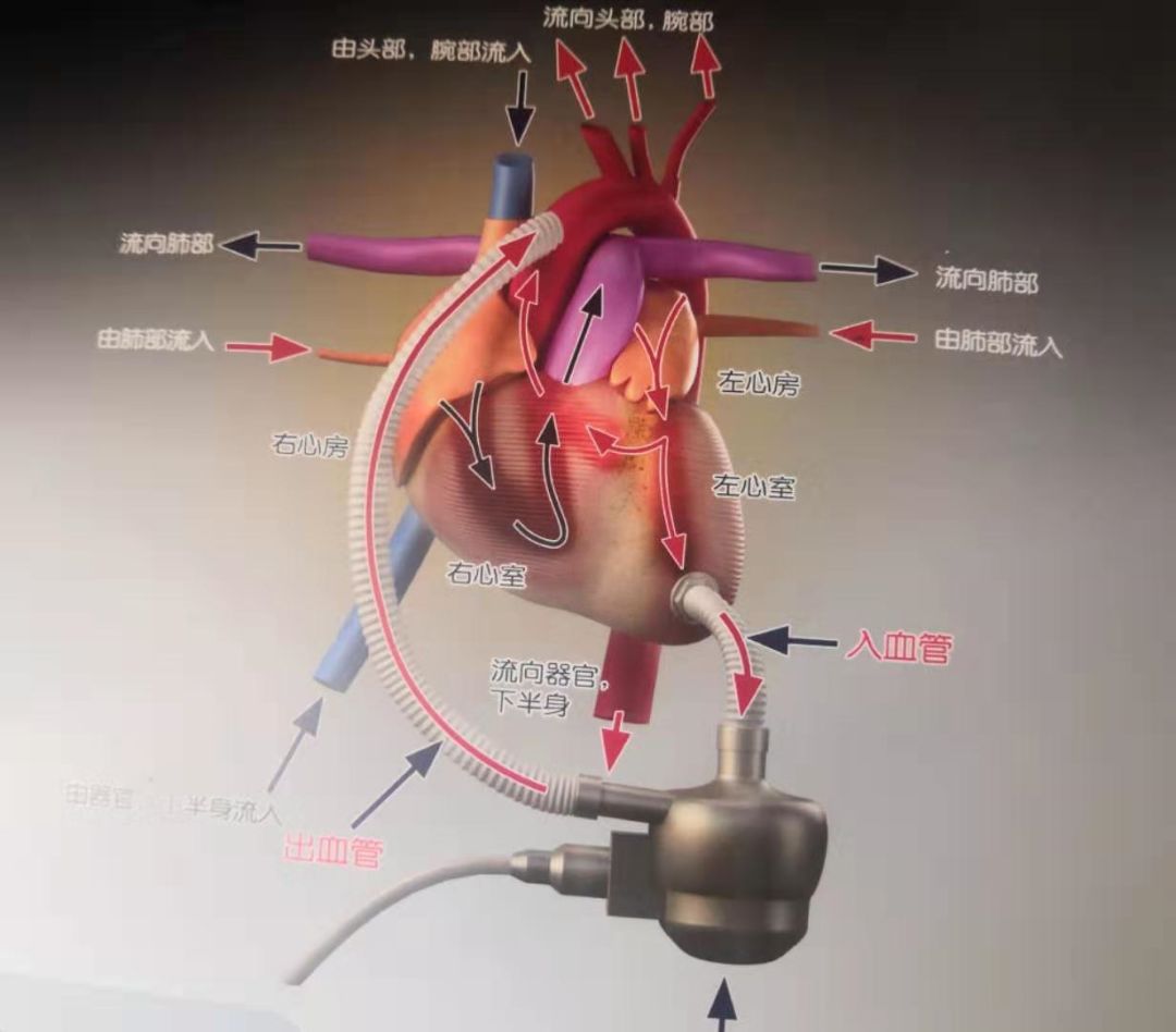 重大科技利好,国内首款"人工心脏"在我市获批上市
