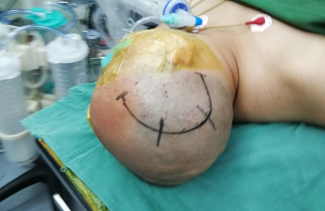 金永健教授团队为患者实施联合血管搭桥手术联合血管搭桥手术血管吻合