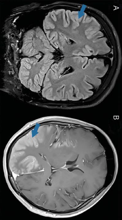 neurology:偏瘫型偏头痛的影像学表现