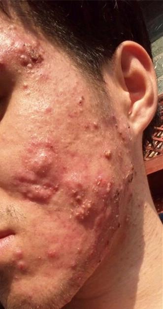 反反复复7年的毛囊炎终于好了,真的不容易_痘痘
