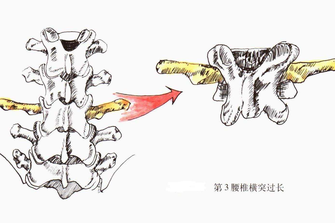 腰三横突综合症,小关节紊乱,手法复位15分钟就能看到效果