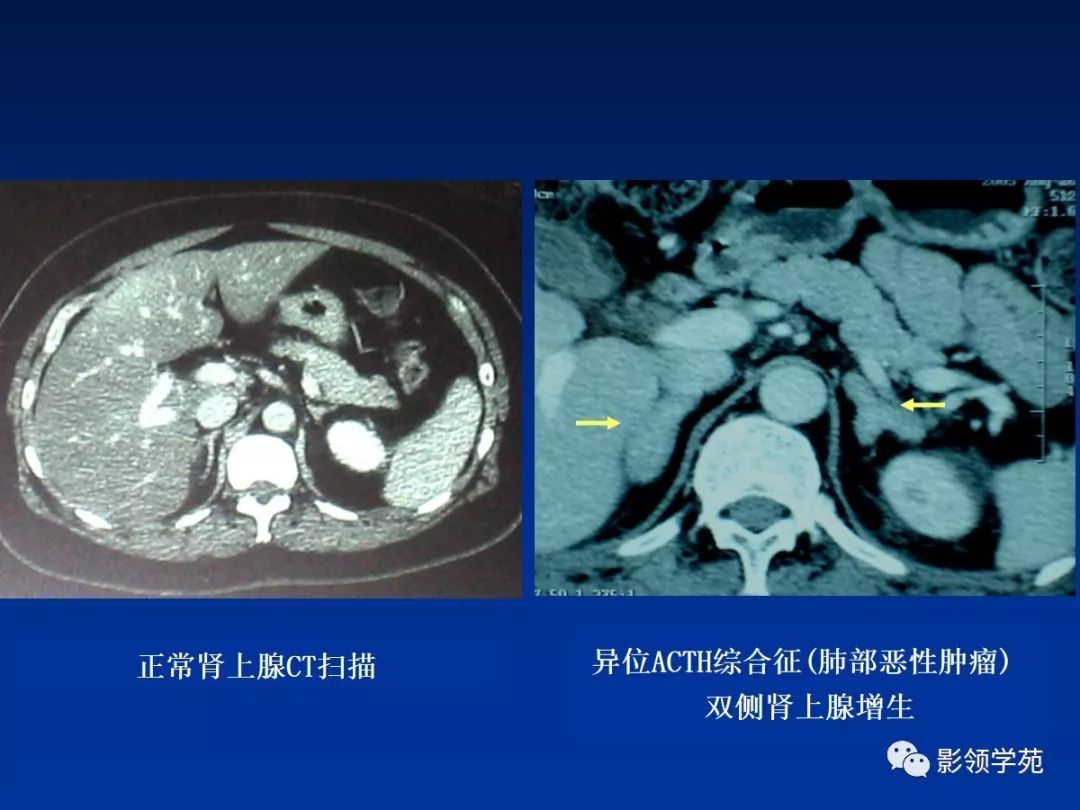 庫欣綜合徵的診斷和治療皮質醇增多症hypercortisolism