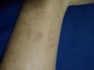 "大腿内侧湿湿痒痒的,用皮清夫软膏凉爽爽的竟然好了"