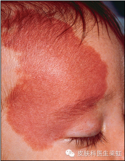 婴幼儿皮肤血管瘤的诊断和治疗选择
