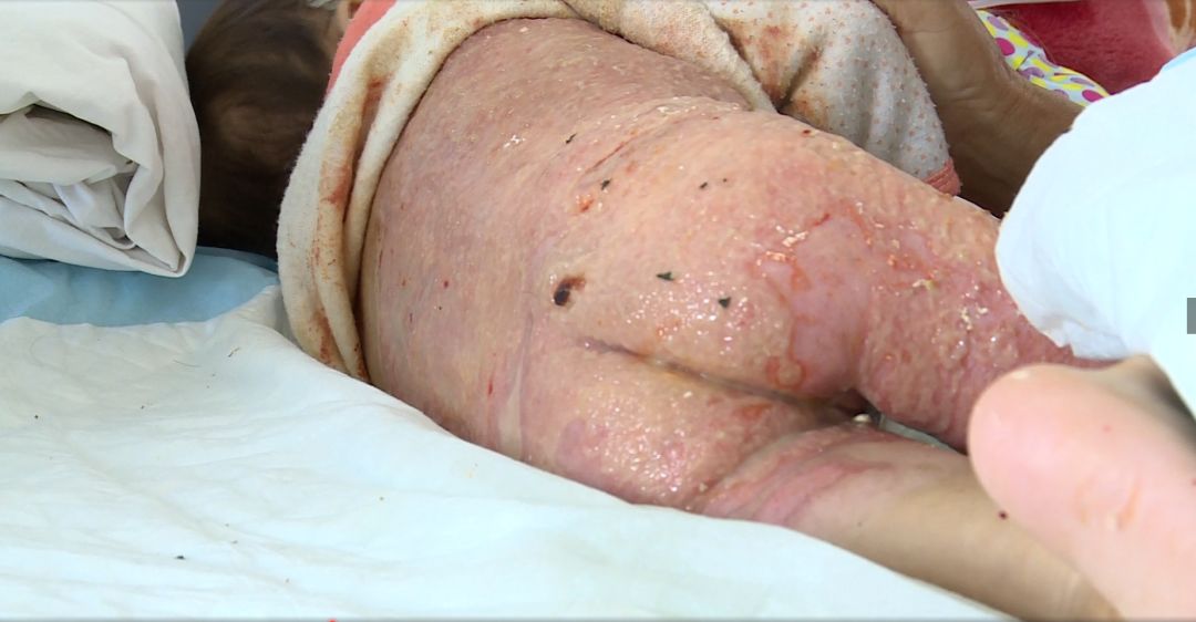 烫伤女孩收到12万捐款,爸爸却这样说