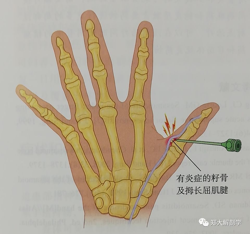 籽骨炎绝大多数发生于拇指,少数发生在食指的屈肌腱内