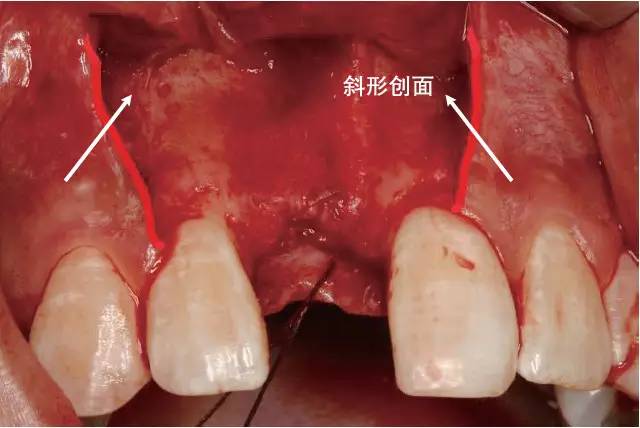 牙医学堂组织切口与瓣的设计翻瓣术切开步骤口腔种植手术学图解