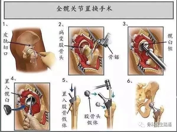 寿命长短的预期等因素,酌情选择采用双极(三极)人工股骨头置换术或