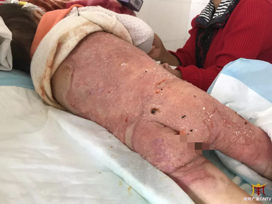 文山州人民医院接受治疗,医院诊断显示,小仙全身31%的皮肤被热液烫伤