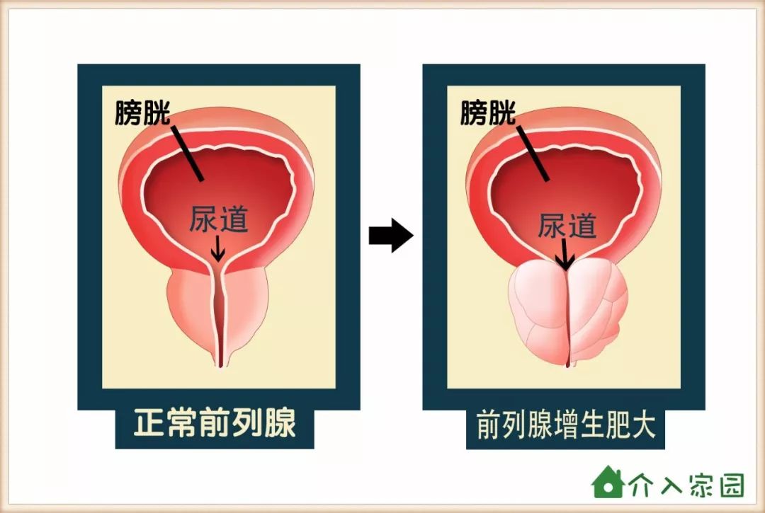 前列腺增生示意图图片