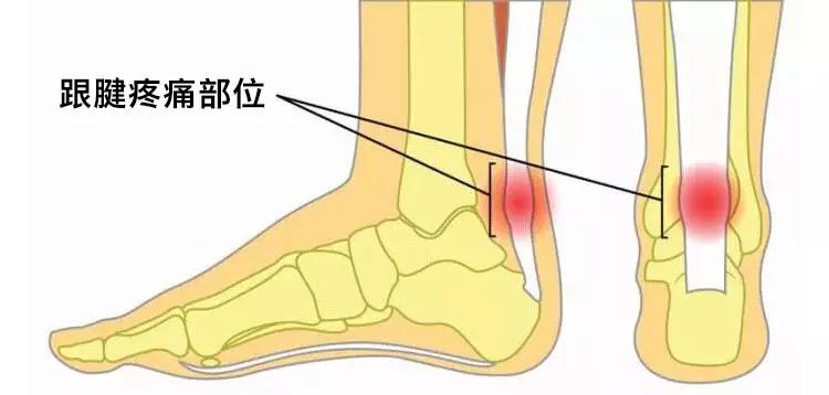 跟腱炎疼痛部位示意圖腳踝肌腱炎疼痛部位示意圖跑步膝疼痛部位示意圖