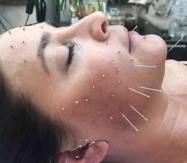 可怕扎针灸刺破双肺新西兰女子连夜进急症室治疗