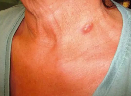 可累及患者的四肢,胸腹壁,乳房和外生殖器,形成游走性皮下结节.1.