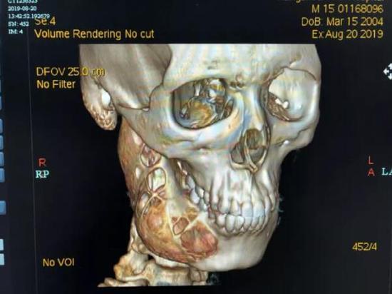 15岁男孩牙疼一年多脸部骨头被吃掉一半