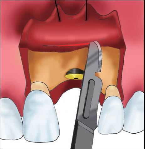 【牙医学堂】组织切口与瓣的设计,翻瓣术切开步骤--口腔种植手术学