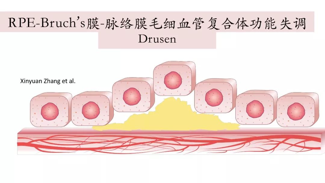 与肥厚型脉络膜相关的drusen肥厚型脉络膜疾病谱是基于oct对脉络膜的
