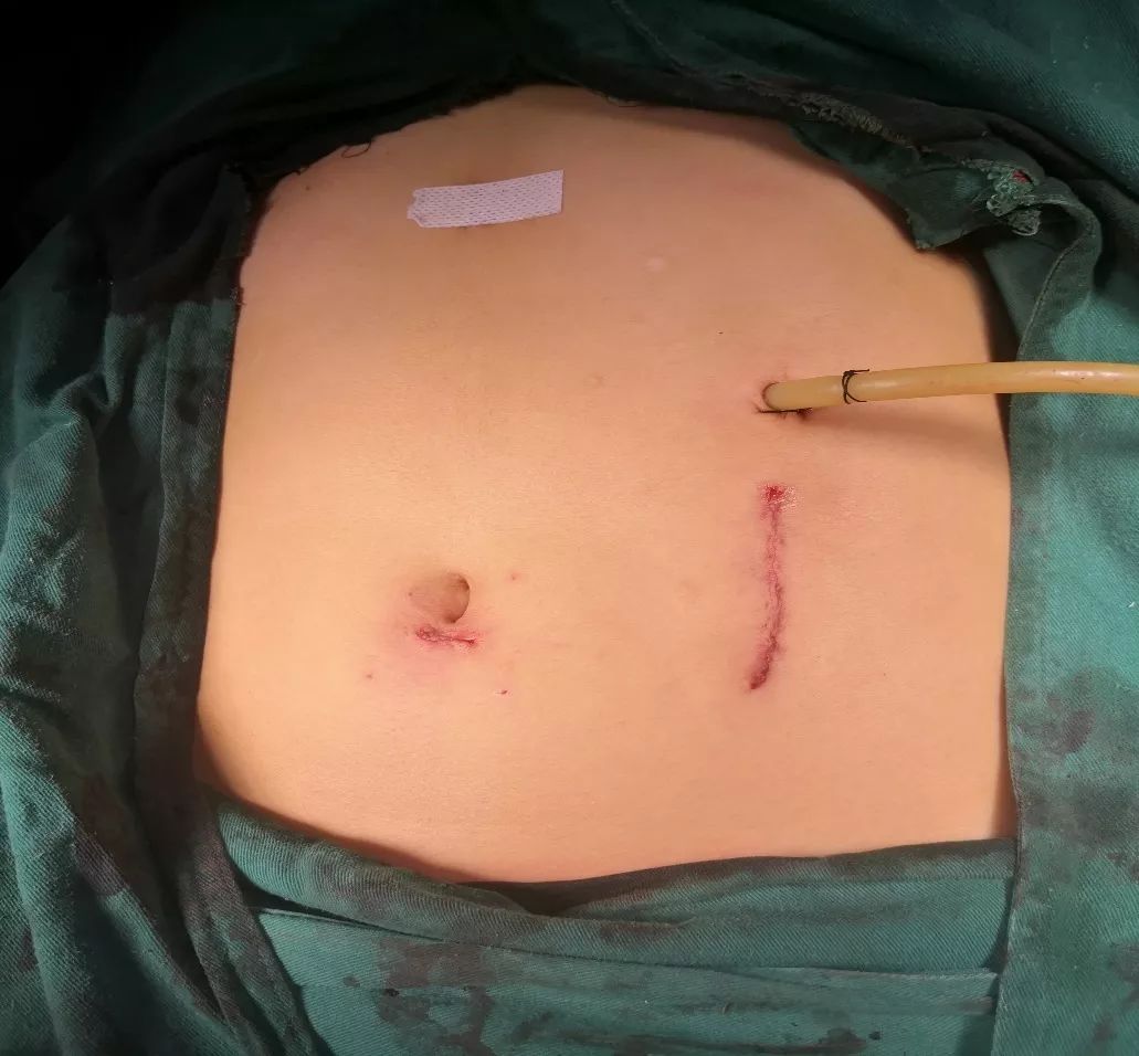 术后切口照片目前腹腔镜下脾切除术已非常成熟.