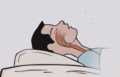 后肌肉放松,气道就变窄了嘴巴会无意识的辅助呼吸打鼾者鼻腔都更窄