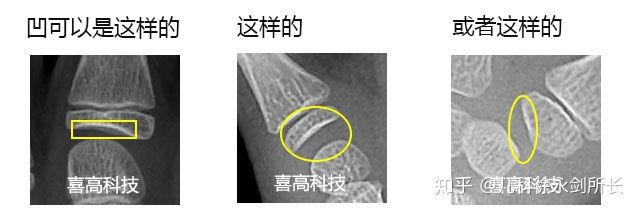 學習中華05標準骨齡鑑定的基礎知識