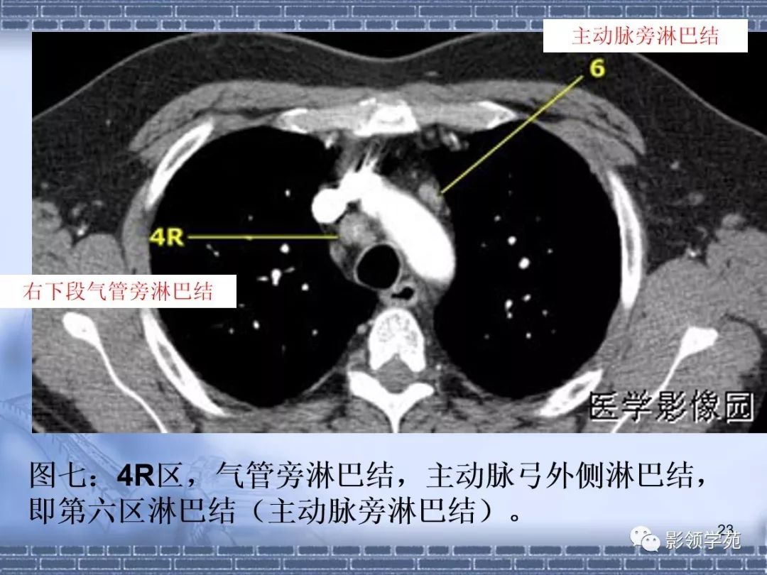 肺癌縱隔淋巴結分區