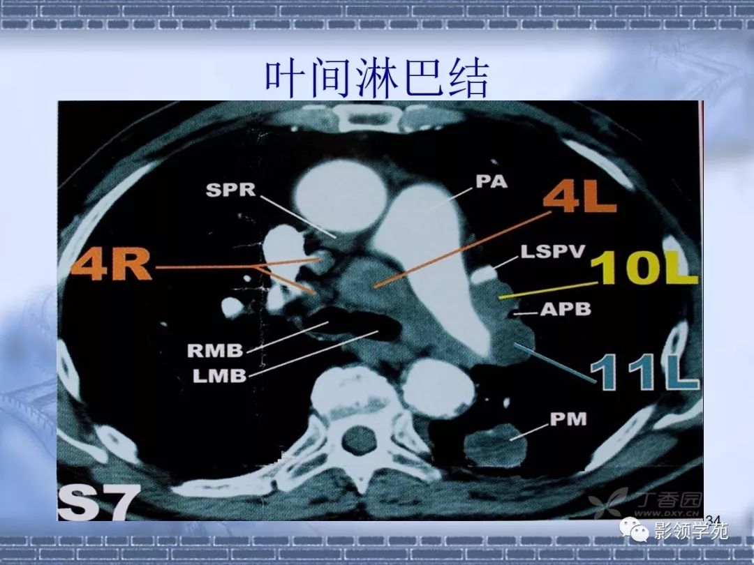 肺癌縱隔淋巴結分區