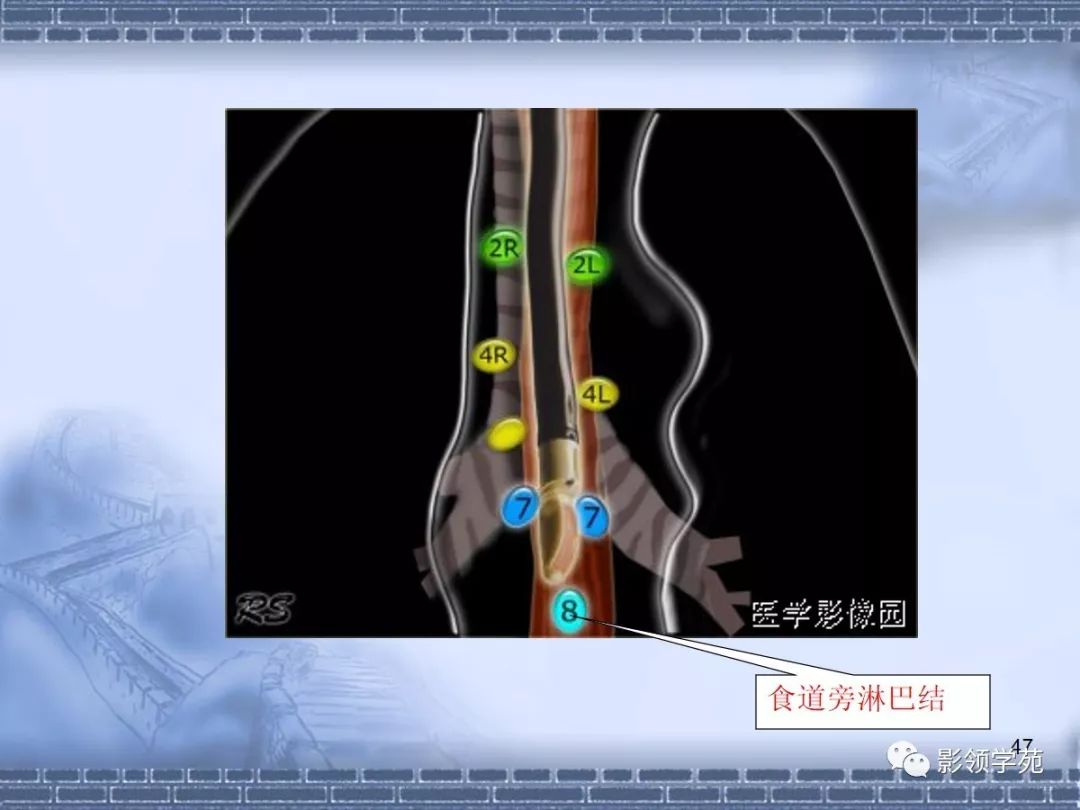 肺癌縱隔淋巴結分區