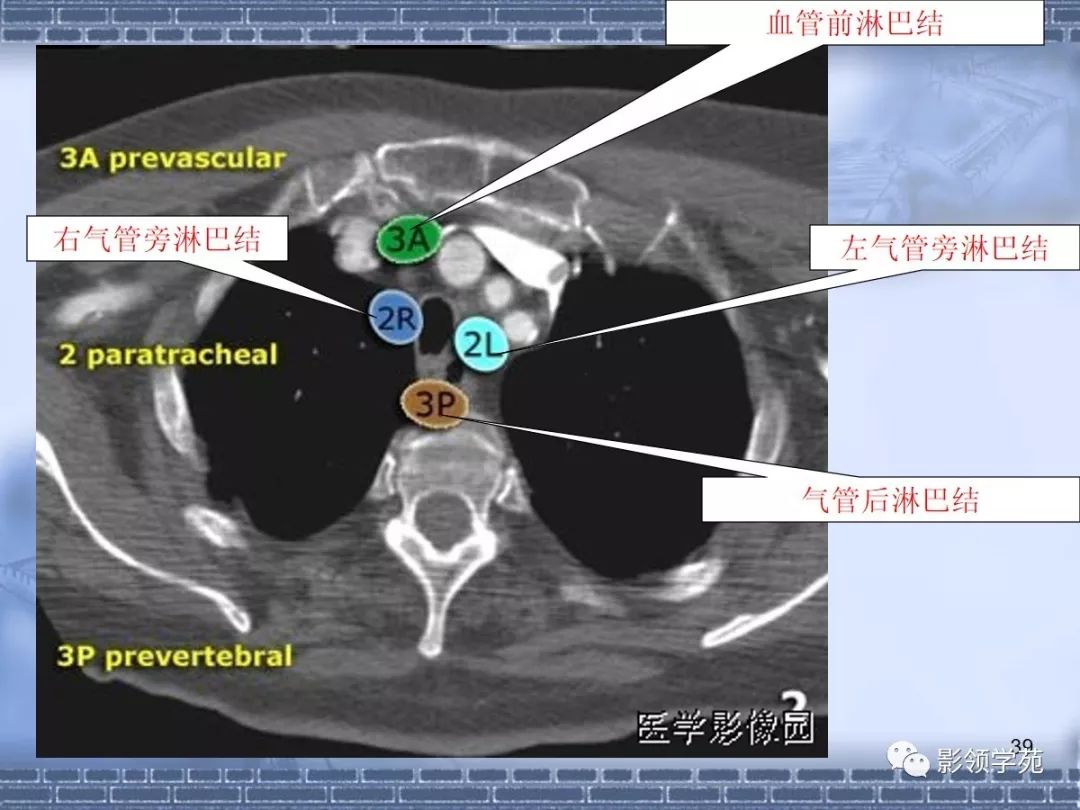 肺癌纵隔淋巴结分区