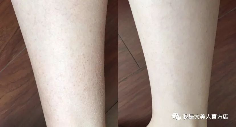 毕竟皮肤有橘皮,脱屑真的很难看.