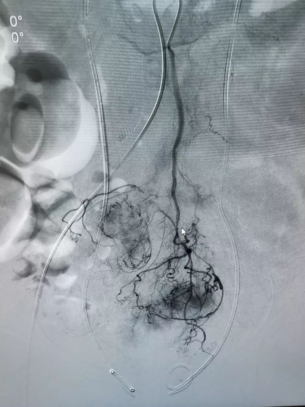 区医疗集团南浔院区成功开展经皮肠系膜下动脉栓塞术