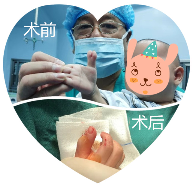 杭州复旦儿童医院冯主任手术还多指宝宝完美未来