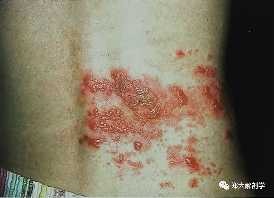 四种引起胸椎的疼痛综合征