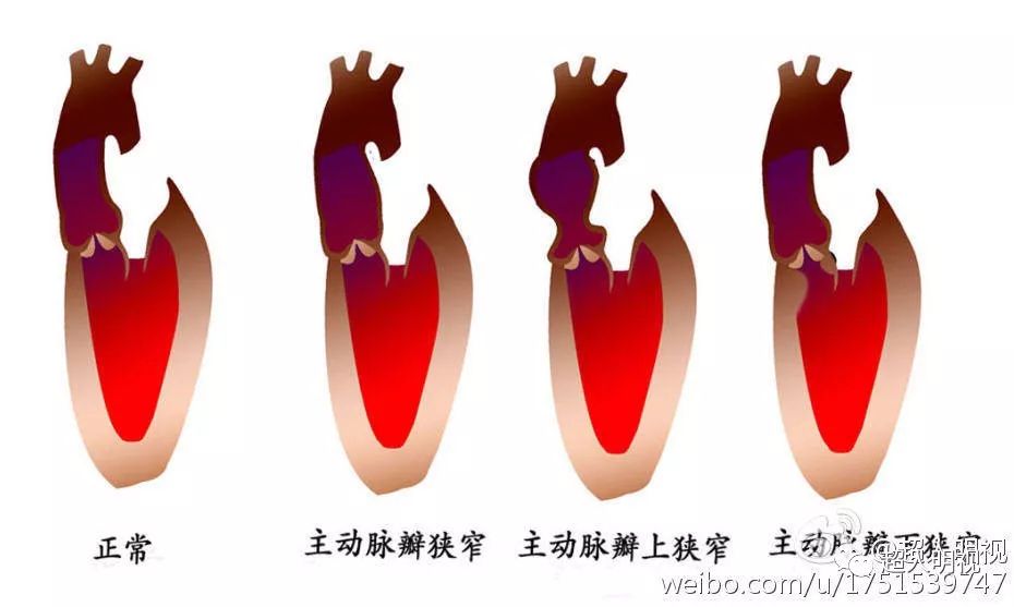 肺動脈狹窄寥寥數語談胎心之二