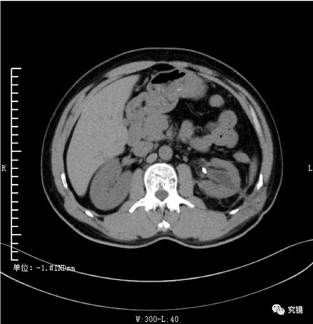 38号作品经皮肾镜术治疗左输尿管上段结石并左肾积水